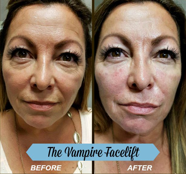 The Vampire Facelift Before & After