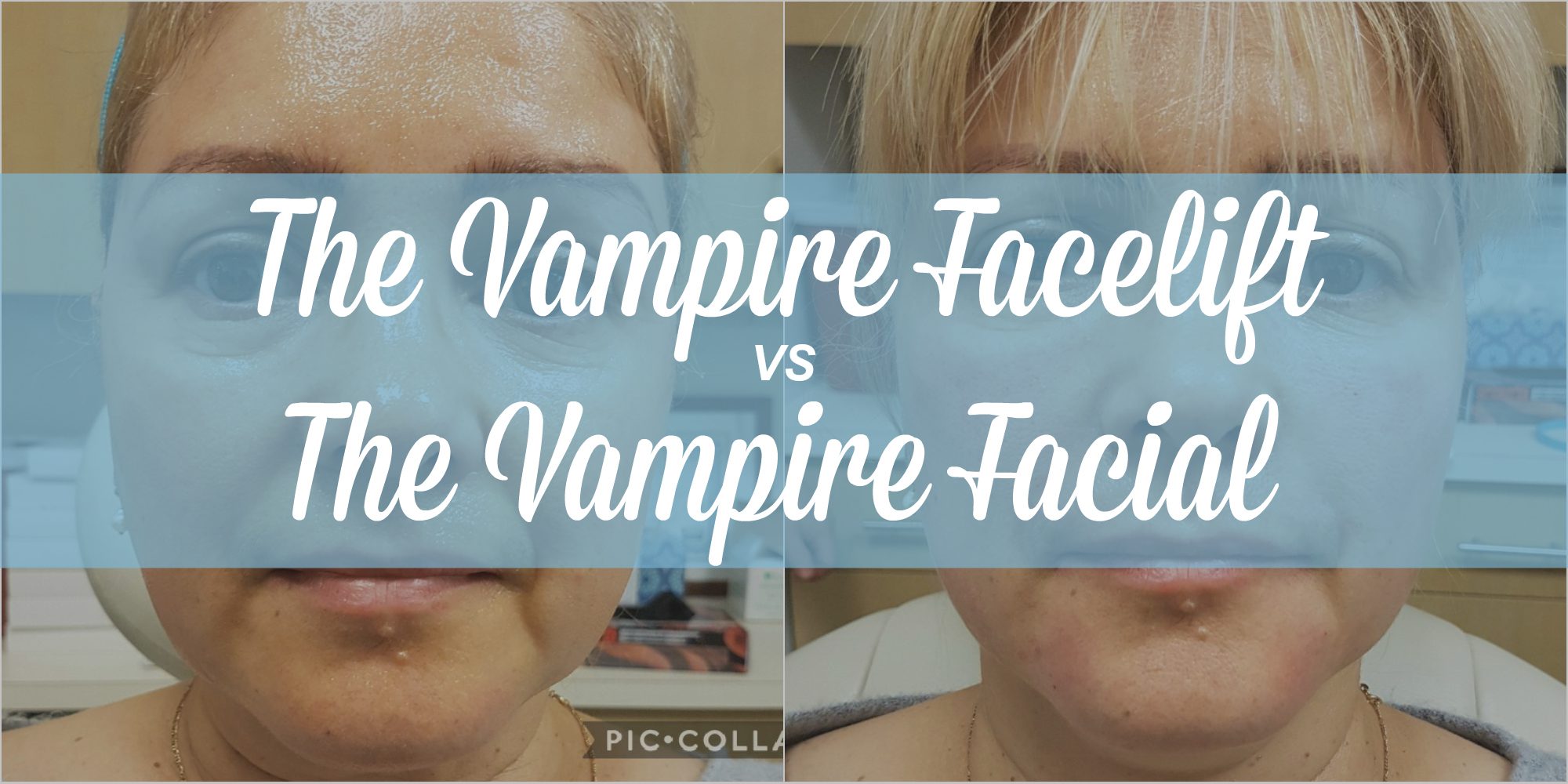 Vampire Facelift vs Vampire Facial