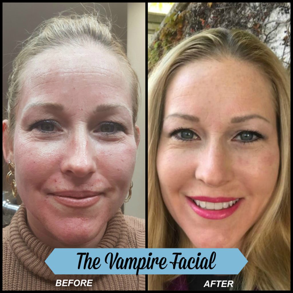 Vampire Facial Before & After.
