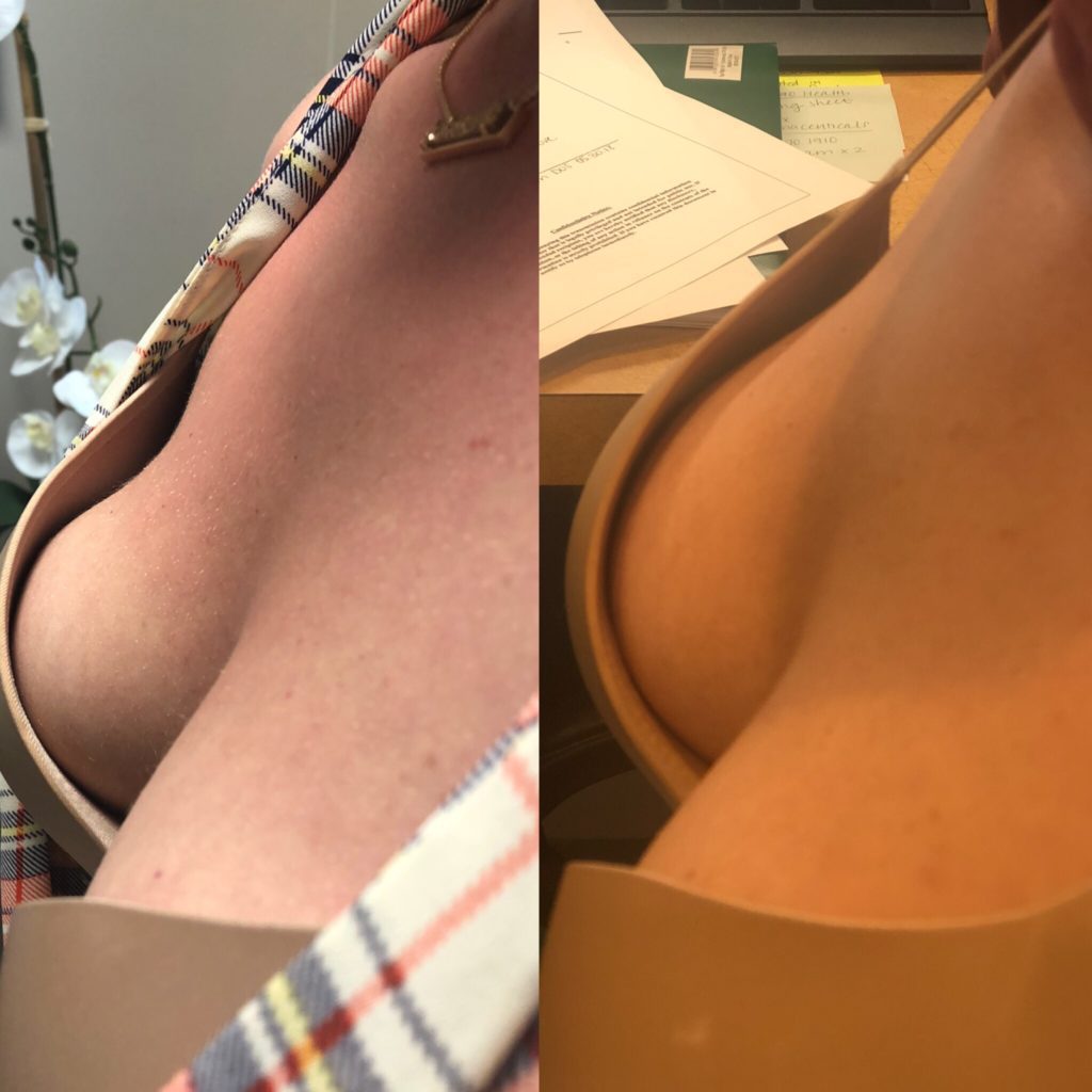Vampire Breast Lift Results After 1 Week - Before and After