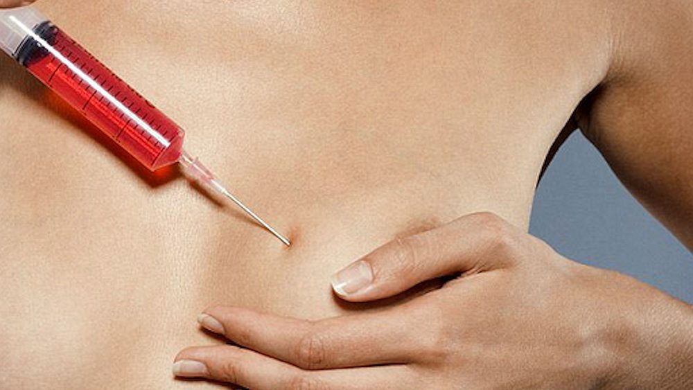 Vial of blood being extracted from breast for Vampire Breastlift.