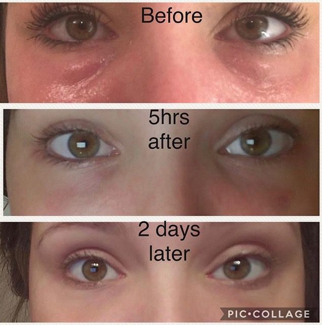 before and after prp under eye treatment